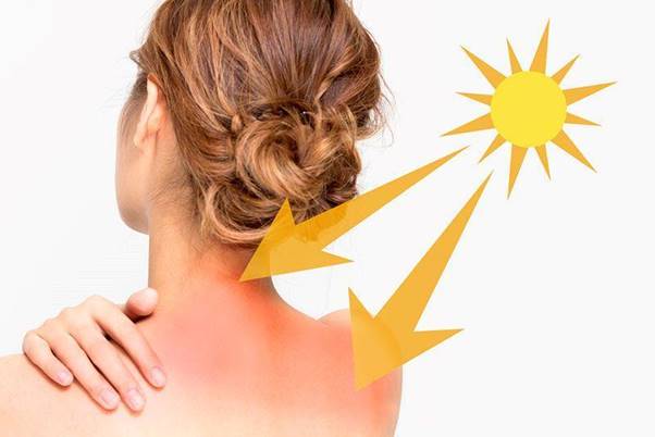 Các mức độ khi làn da bị cháy nắng bạn cần biết