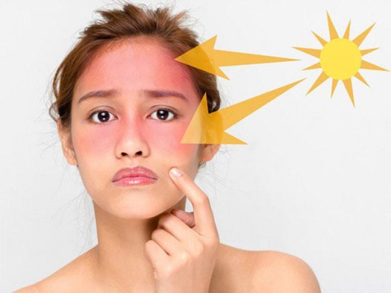 Mẹo đơn giản giúp phục hồi nhanh làn da bị cháy nắng