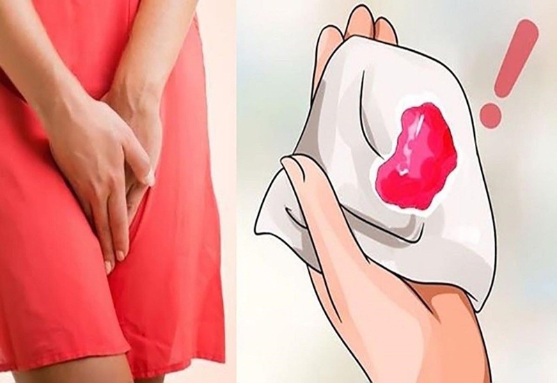 Dấu hiệu bệnh phụ khoa là chảy máu bất thường