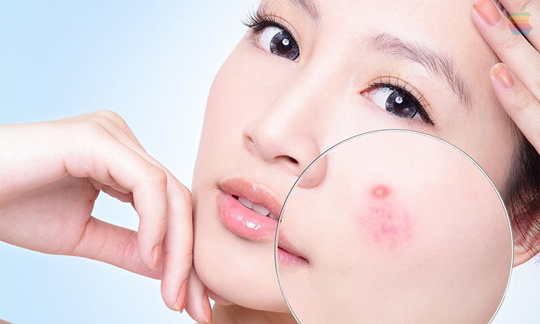 Tại sao đến kỳ kinh nguyệt chị em hay bị nổi mụn nội tiết