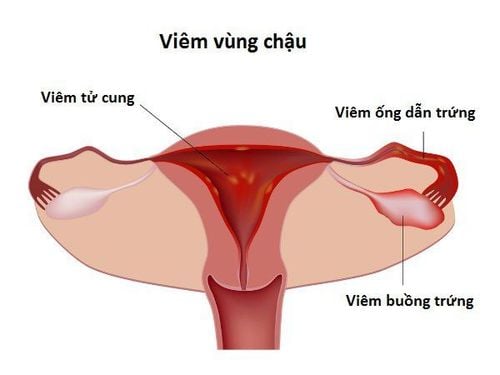 Viêm vùng chậu có nguy cơ gây vô sinh