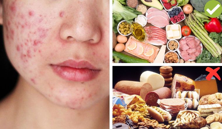 6 Loại Trái Cây Ăn Nhiều Dễ Nổi Mụn Bạn Nên Tránh